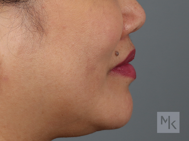 Lip Lift Before and After | Dr. Michael Kim