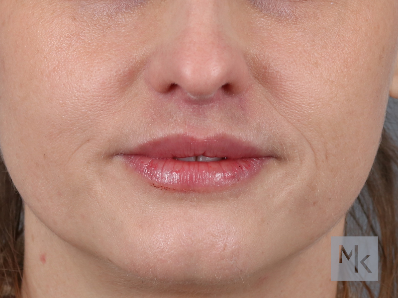 Lip Lift Before and After | Dr. Michael Kim