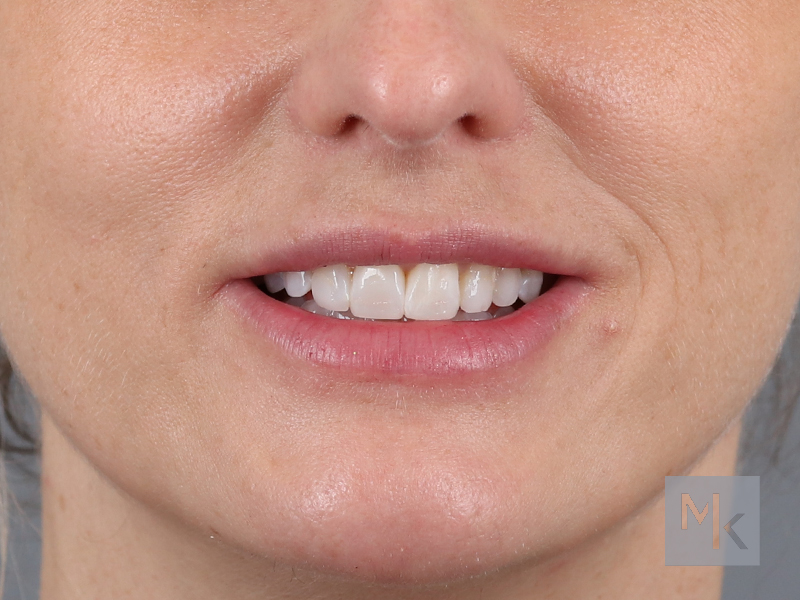 Lip Lift Before and After | Dr. Michael Kim