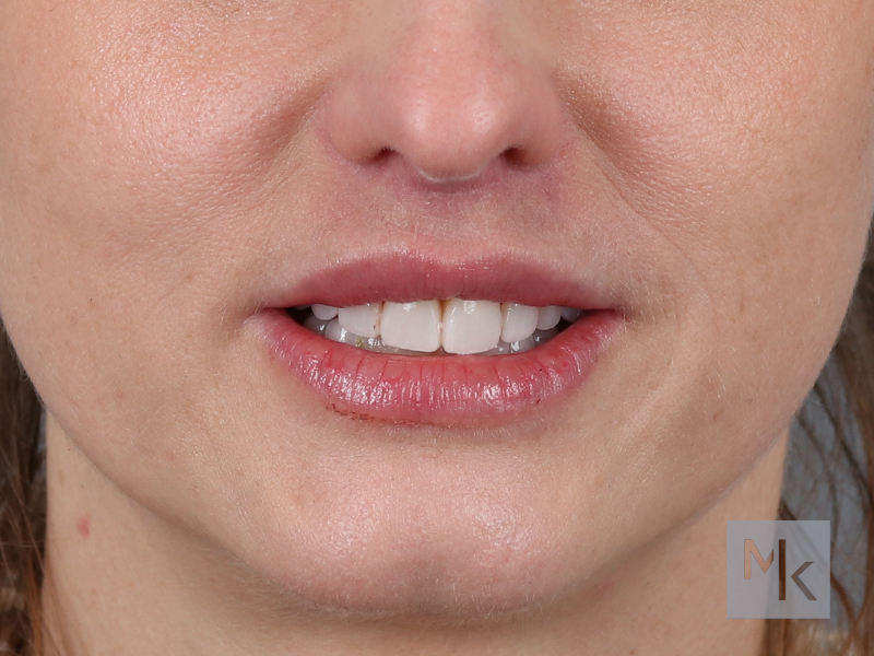 Lip Lift Before and After | Dr. Michael Kim