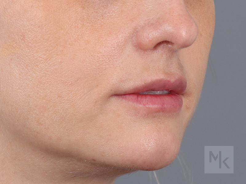 Lip Lift Before and After | Dr. Michael Kim