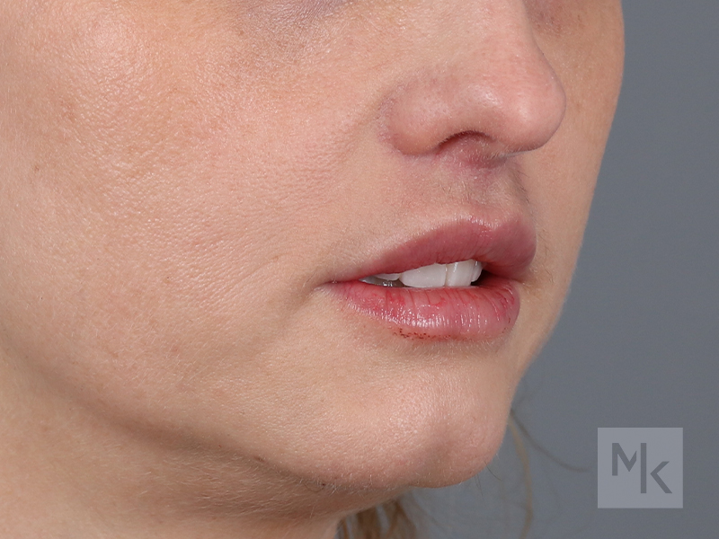 Lip Lift Before and After | Dr. Michael Kim