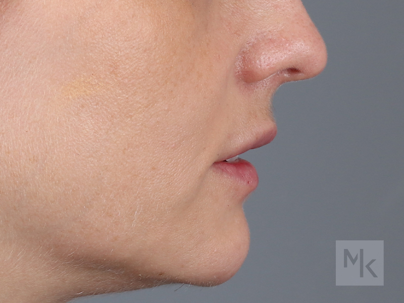 Lip Lift Before and After | Dr. Michael Kim