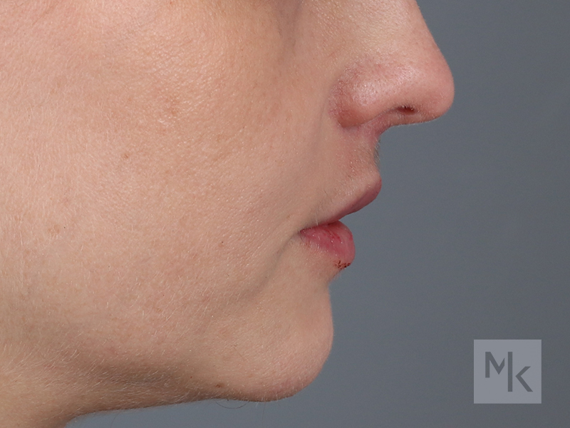 Lip Lift Before and After | Dr. Michael Kim