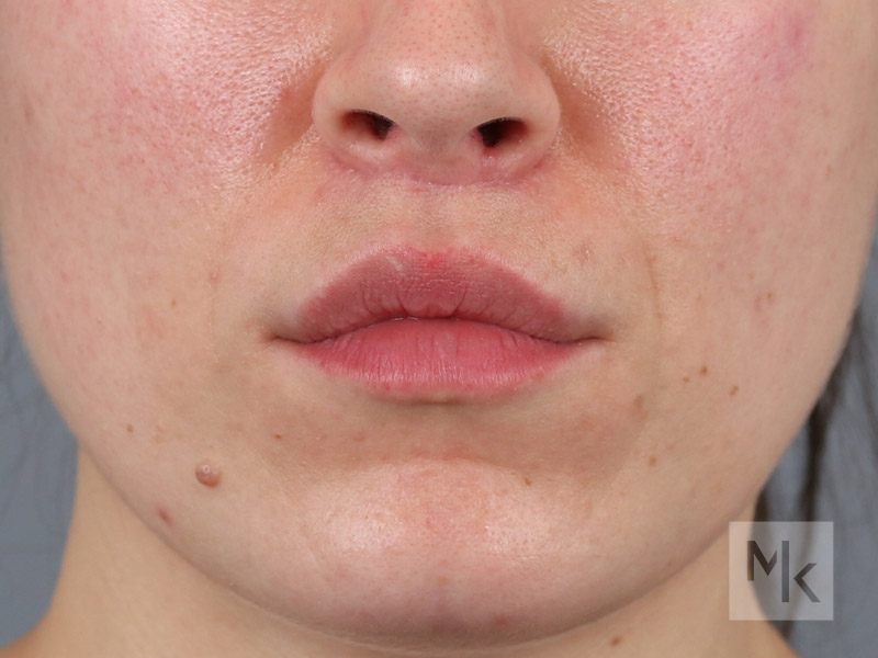 Lip Lift Before and After | Dr. Michael Kim