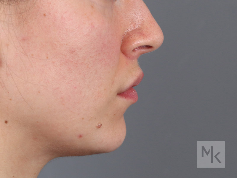 Lip Lift Before and After | Dr. Michael Kim