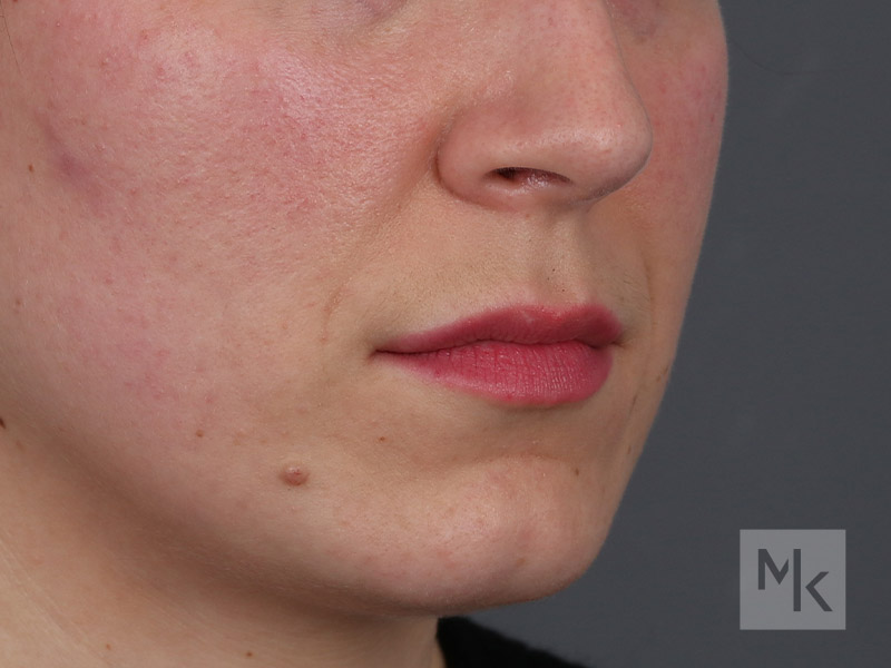 Lip Lift Before and After | Dr. Michael Kim