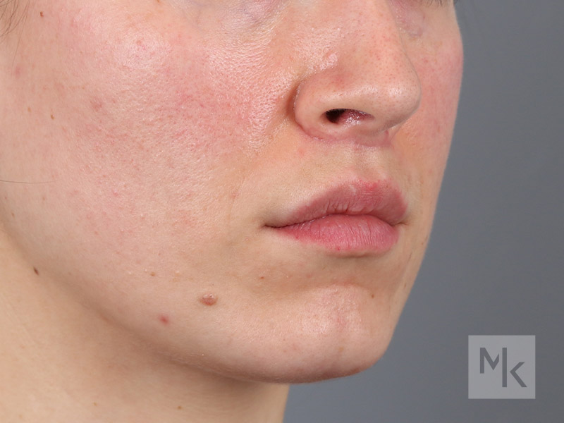 Lip Lift Before and After | Dr. Michael Kim