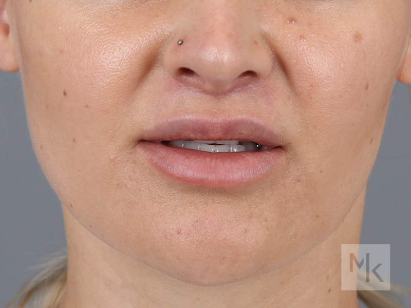 Lip Lift Before and After | Dr. Michael Kim