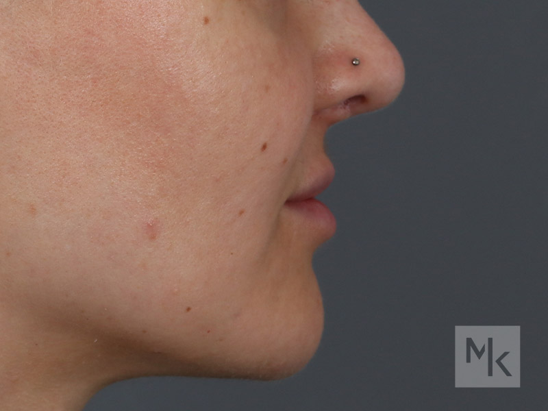 Lip Lift Before and After | Dr. Michael Kim