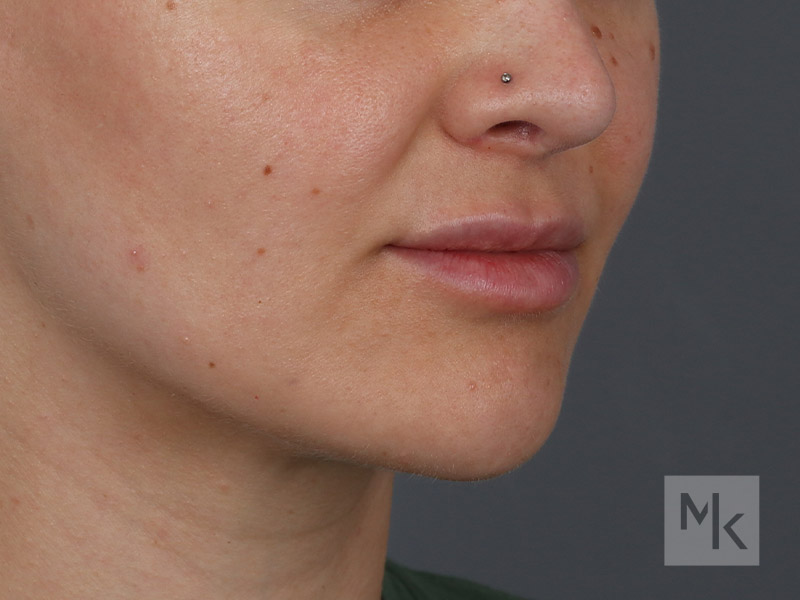 Lip Lift Before and After | Dr. Michael Kim