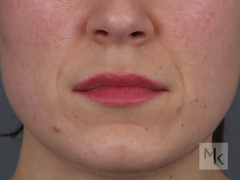 Lip Lift Before and After | Dr. Michael Kim