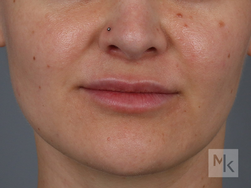 Lip Lift Before and After | Dr. Michael Kim