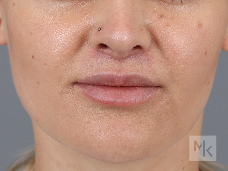 Lip Lift Before and After | Dr. Michael Kim