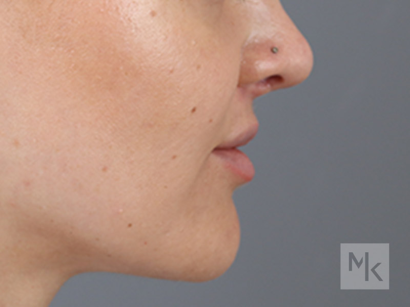 Lip Lift Before and After | Dr. Michael Kim