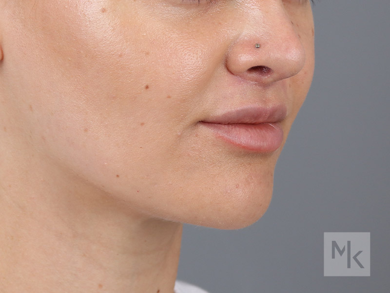 Lip Lift Before and After | Dr. Michael Kim