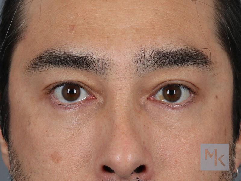 Lower Blepharoplasty Before and After | Dr. Michael Kim