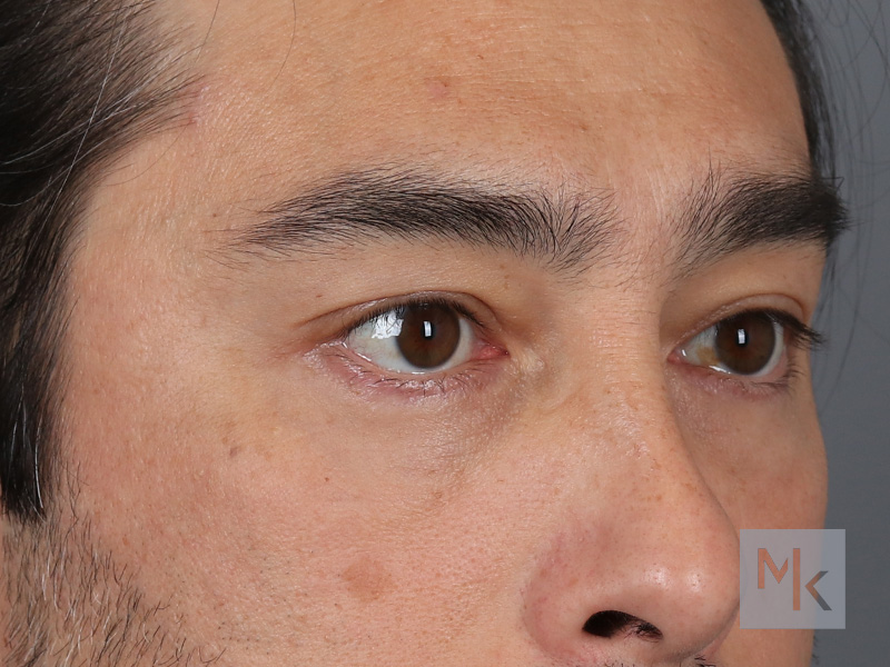 Lower Blepharoplasty Before and After | Dr. Michael Kim