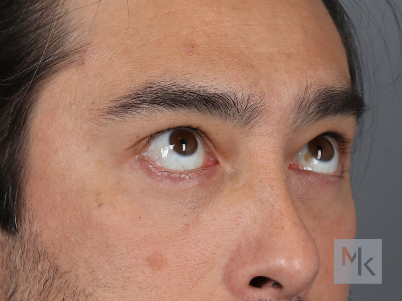 Lower Blepharoplasty Before and After | Dr. Michael Kim