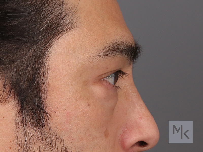 Lower Blepharoplasty Before and After | Dr. Michael Kim