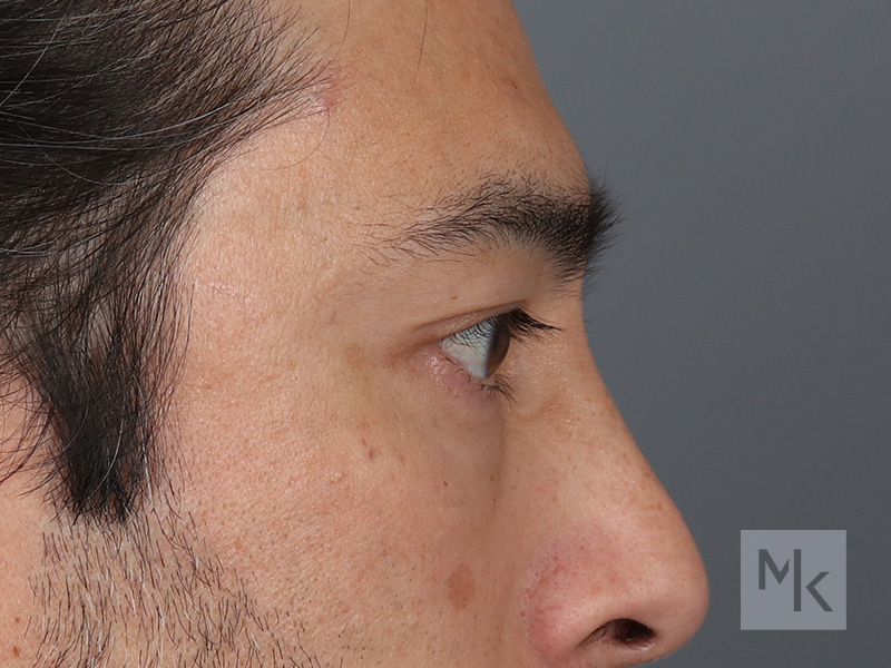 Lower Blepharoplasty Before and After | Dr. Michael Kim