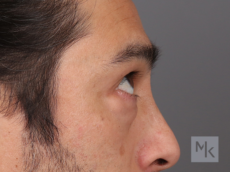 Lower Blepharoplasty Before and After | Dr. Michael Kim