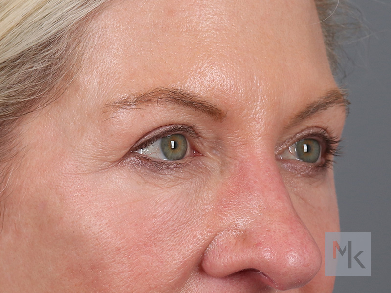 Lower Blepharoplasty Before and After | Dr. Michael Kim