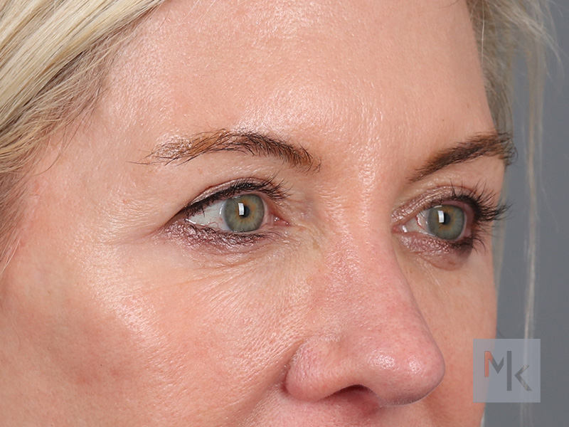 Lower Blepharoplasty Before and After | Dr. Michael Kim