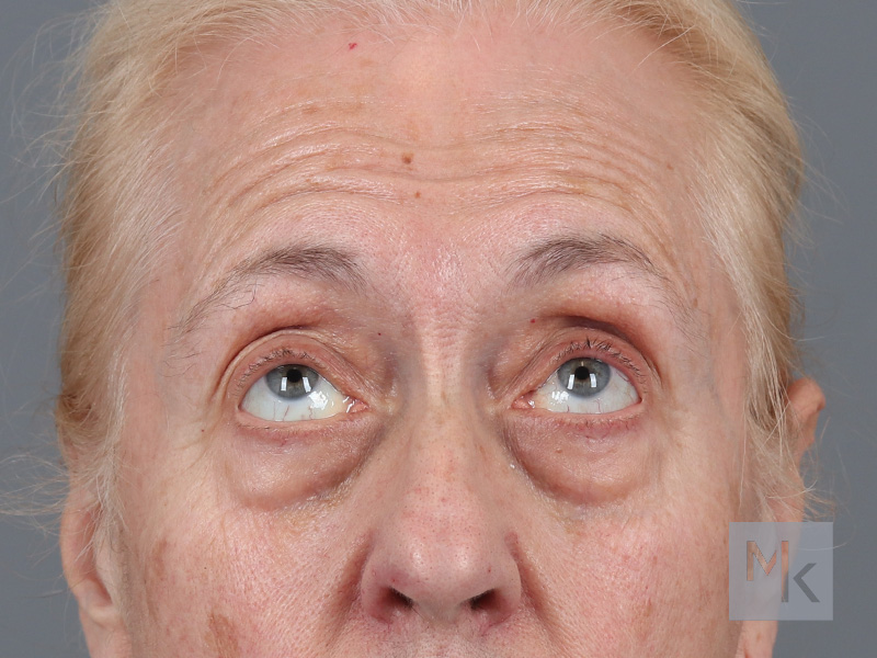 Lower Blepharoplasty Before and After | Dr. Michael Kim