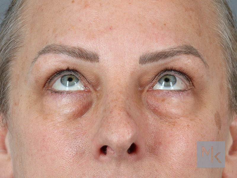 Lower Blepharoplasty Before and After | Dr. Michael Kim