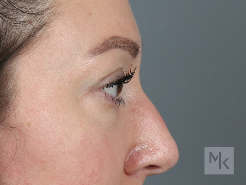 Lower Blepharoplasty Before and After | Dr. Michael Kim