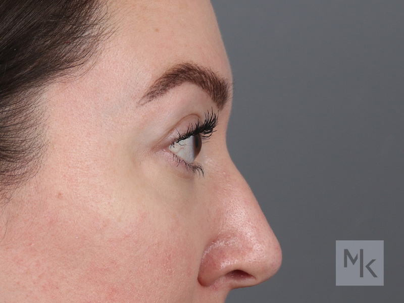 Lower Blepharoplasty Before and After | Dr. Michael Kim