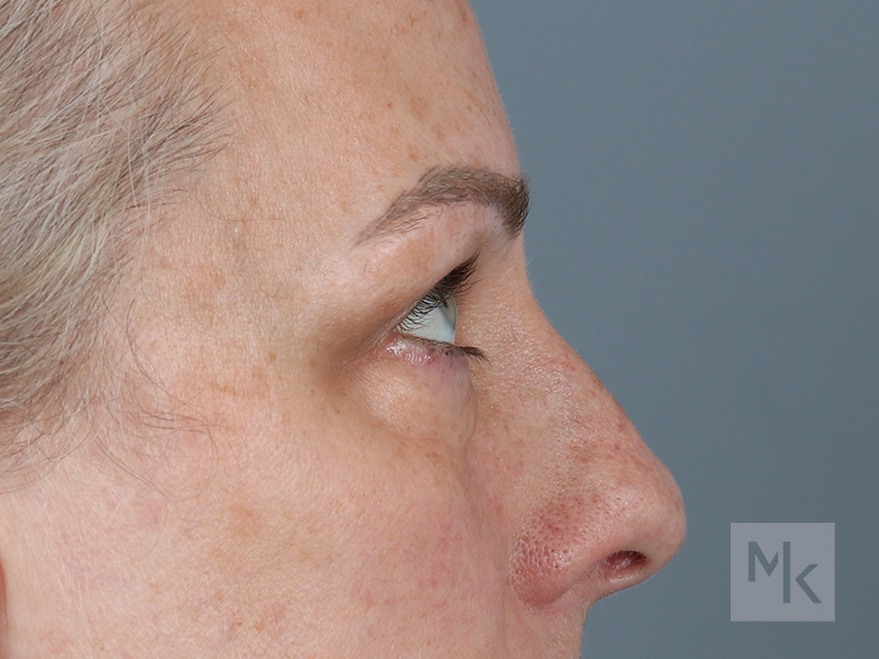 Lower Blepharoplasty Before and After | Dr. Michael Kim