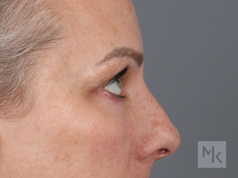 Lower Blepharoplasty Before and After | Dr. Michael Kim