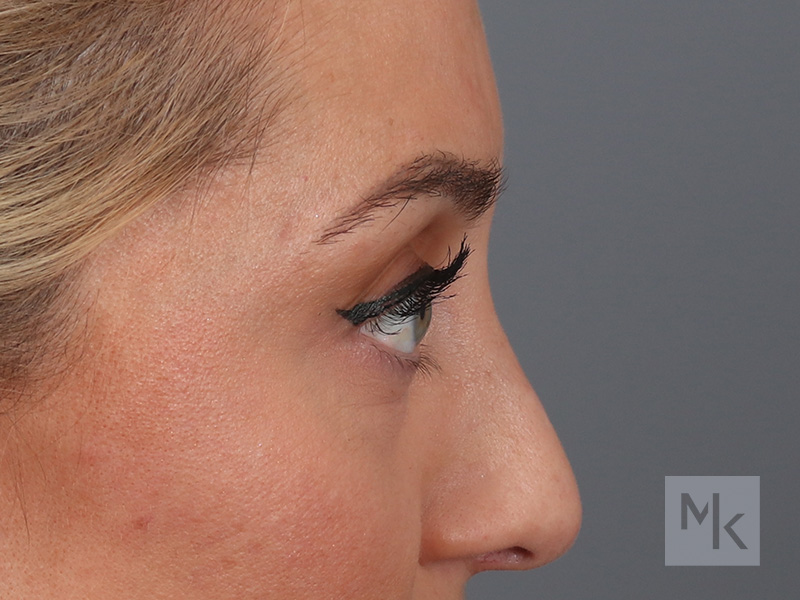 Lower Blepharoplasty Before and After | Dr. Michael Kim