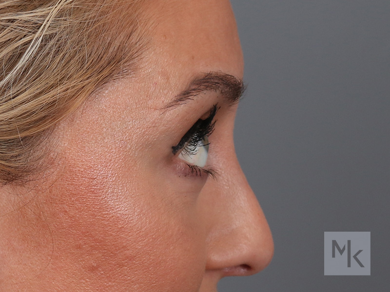 Lower Blepharoplasty Before and After | Dr. Michael Kim