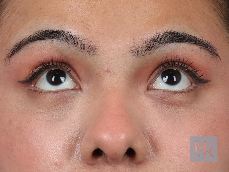 Lower Blepharoplasty Before and After | Dr. Michael Kim