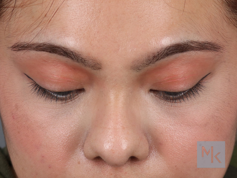 Lower Blepharoplasty Before and After | Dr. Michael Kim