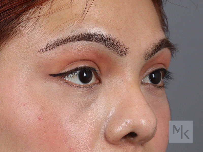 Lower Blepharoplasty Before and After | Dr. Michael Kim