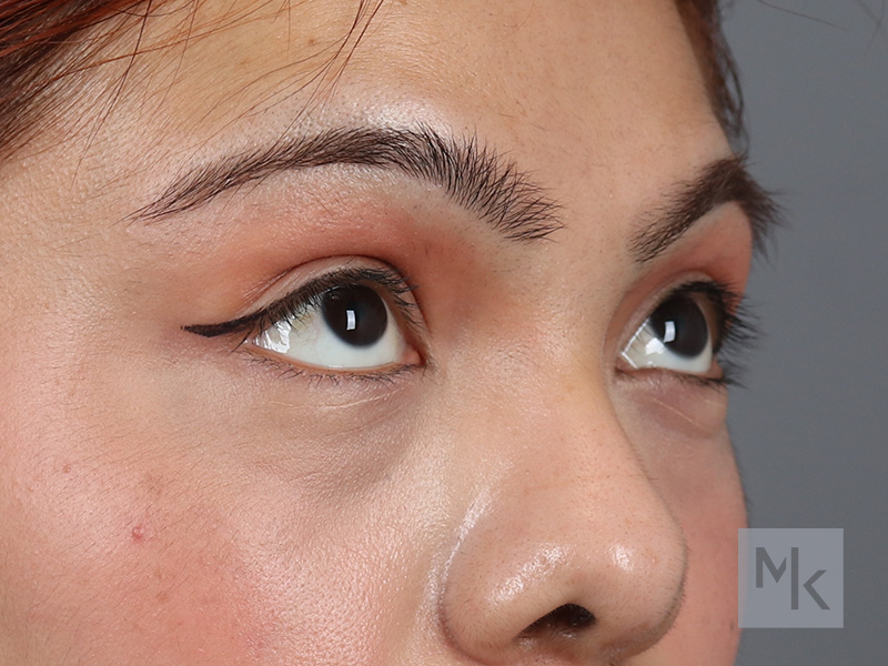 Lower Blepharoplasty Before and After | Dr. Michael Kim