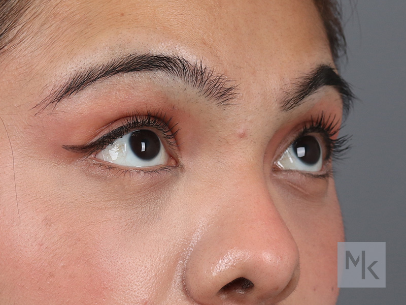 Lower Blepharoplasty Before and After | Dr. Michael Kim