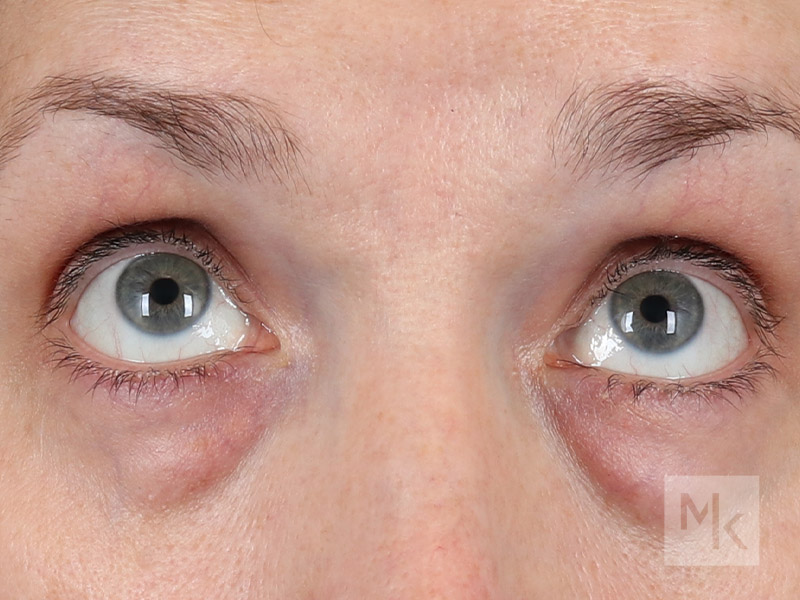 Lower Blepharoplasty Before and After | Dr. Michael Kim