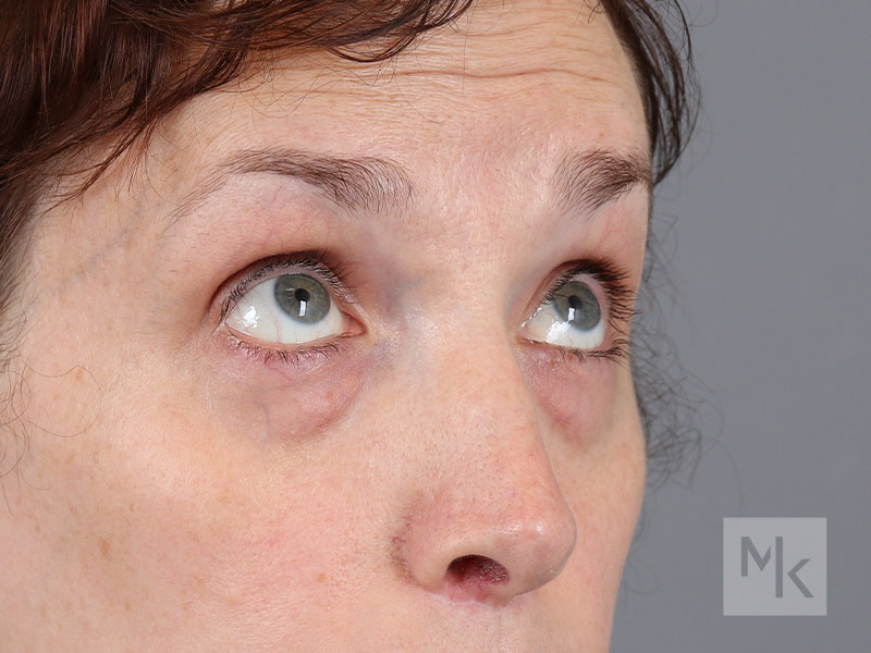 Lower Blepharoplasty Before and After | Dr. Michael Kim