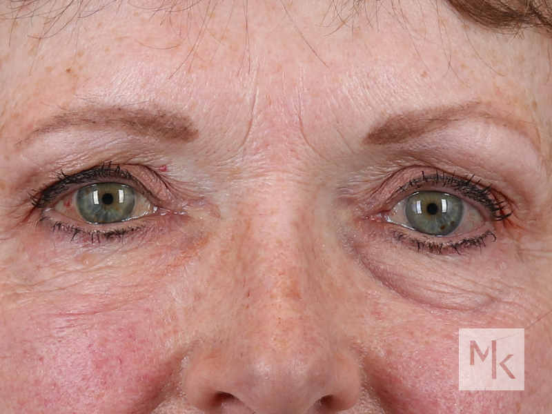 Lower Blepharoplasty Before and After | Dr. Michael Kim