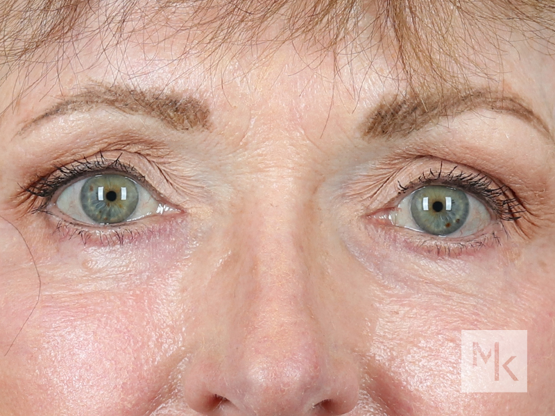 Lower Blepharoplasty Before and After | Dr. Michael Kim