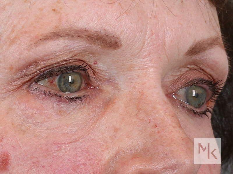 Lower Blepharoplasty Before and After | Dr. Michael Kim