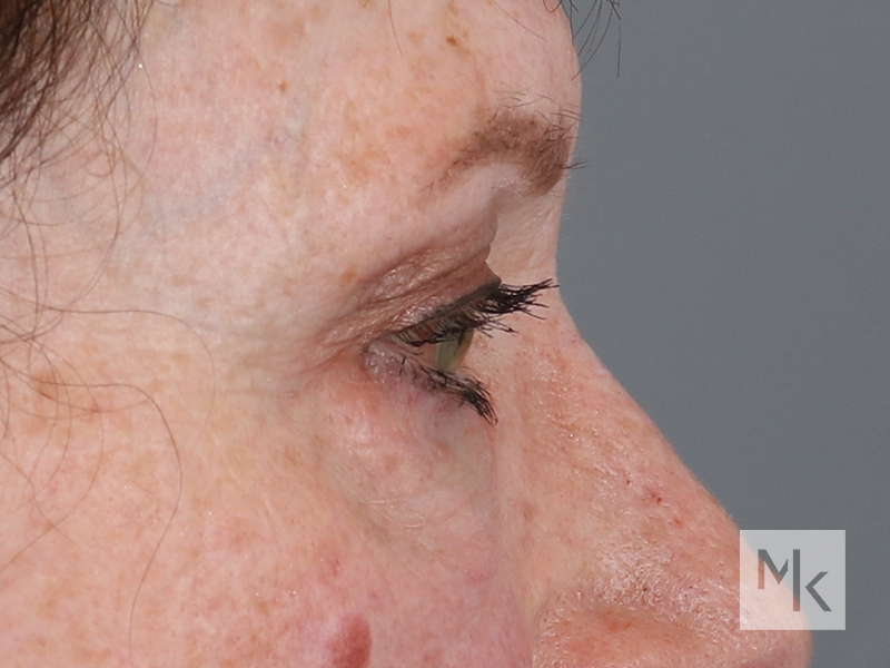 Lower Blepharoplasty Before and After | Dr. Michael Kim