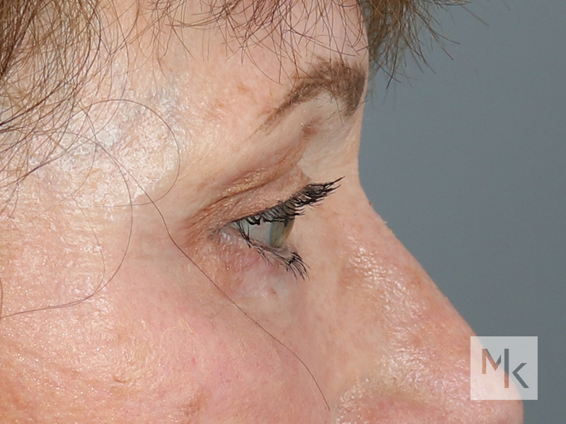 Lower Blepharoplasty Before and After | Dr. Michael Kim