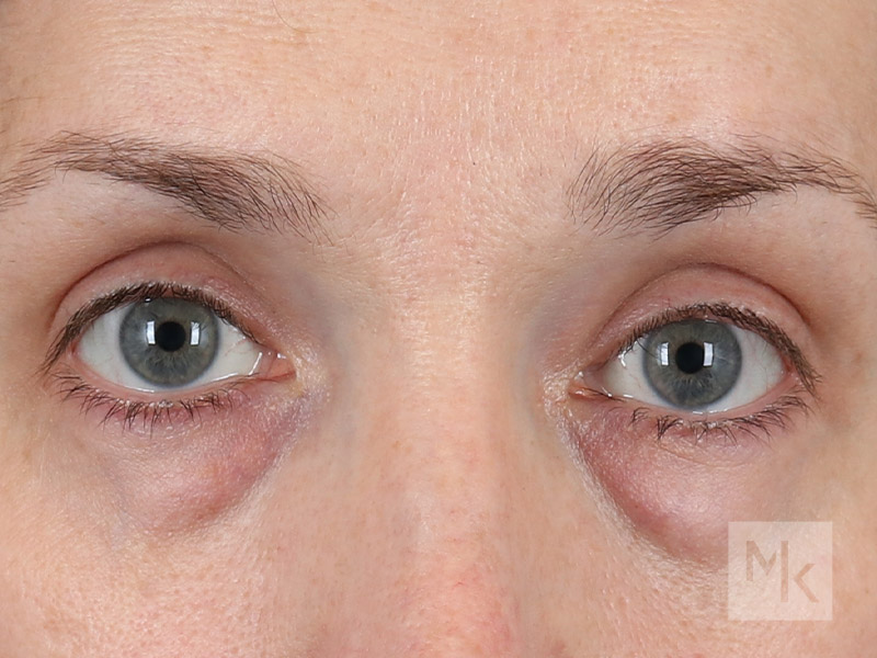 Lower Blepharoplasty Before and After | Dr. Michael Kim