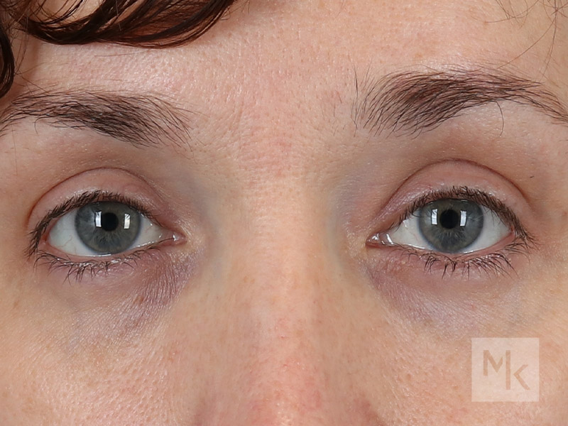 Lower Blepharoplasty Before and After | Dr. Michael Kim